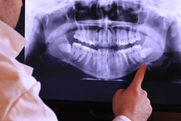 Best Emergency Wisdom Tooth Extraction in Halesite, NY
